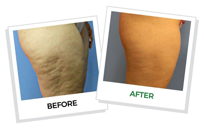 Cold Fat Removal Treatment Emerald Laser By Erchnoia