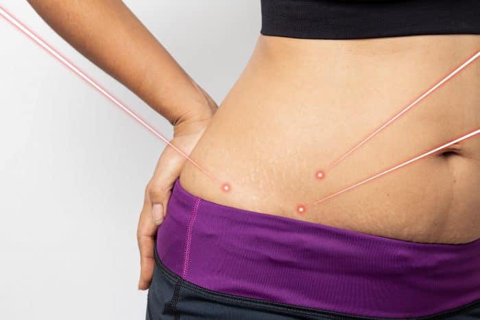 lasers targeting a womans hips and stomach for weight loss treatment
