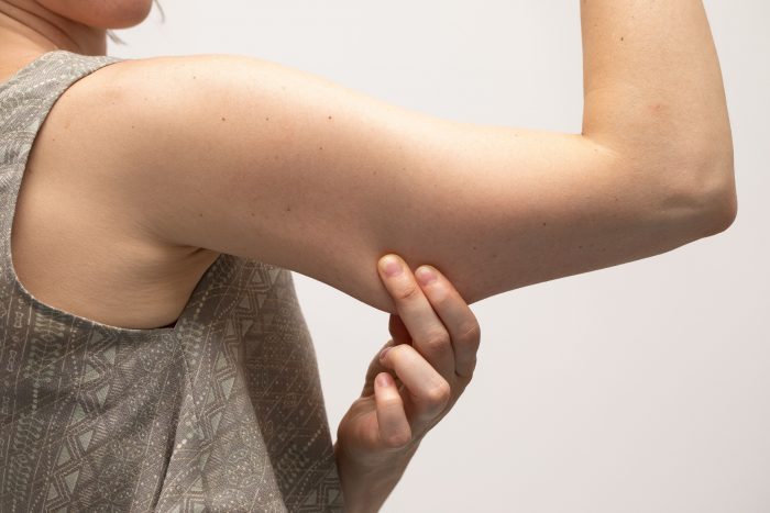 a woman pinches fat on her arm while considering laser lipolysis