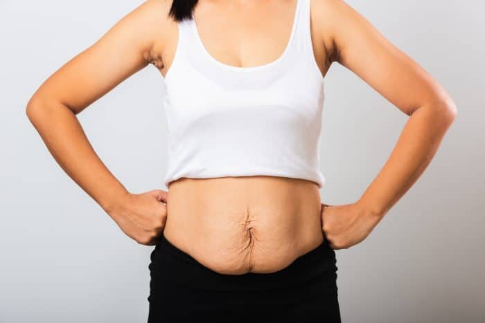 New mother using laser lipo to help with weight loss after pregnancy