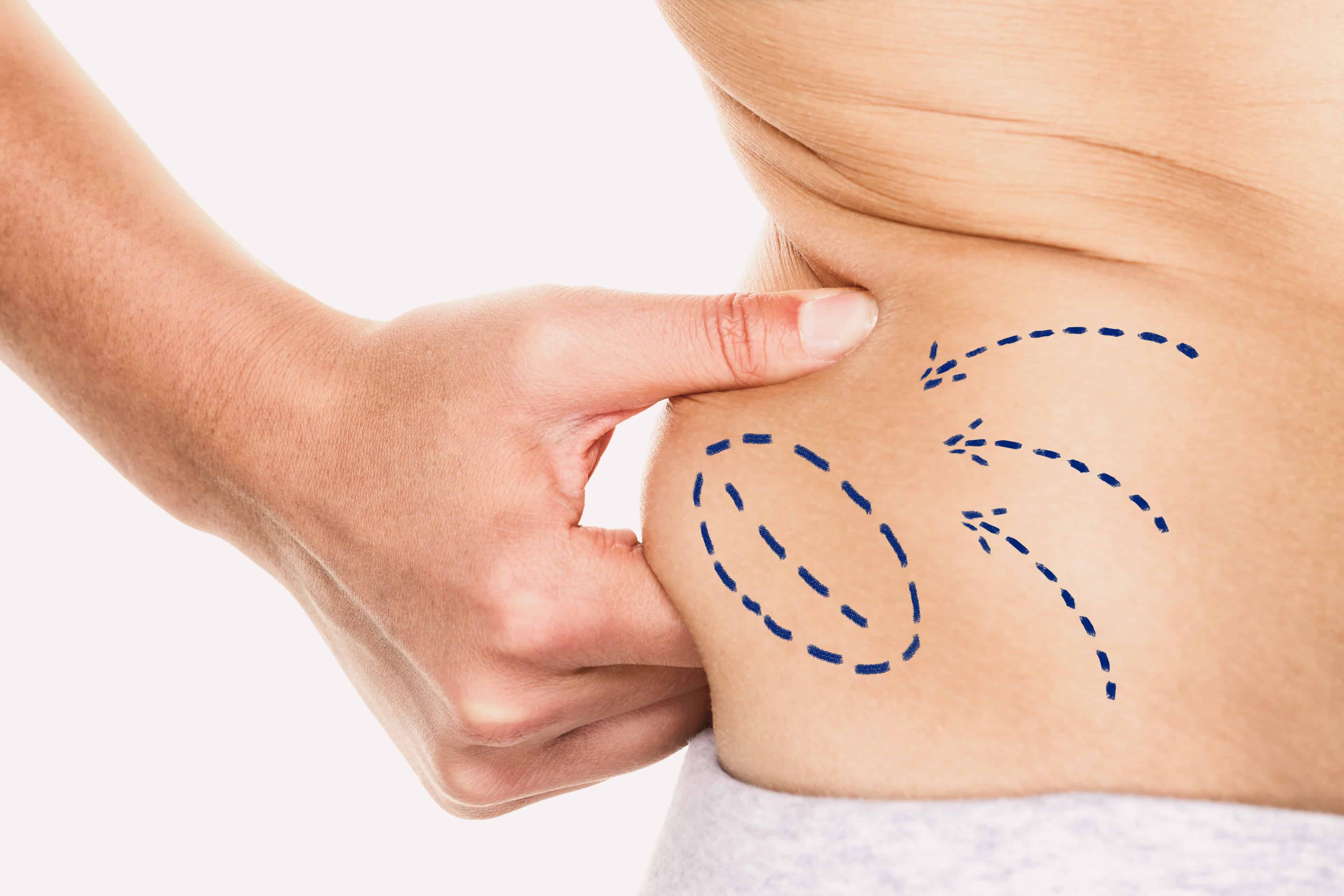 Woman pinching love handles. Arrows point to area with excess fat.