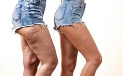 Two images of women in cutoffs — one with cellulite and one without