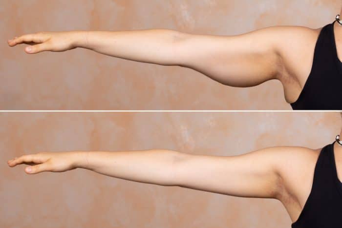 two pictures: the top one shows a woman's arm with flabby skin while the bottom shows a tighter, firmer arm