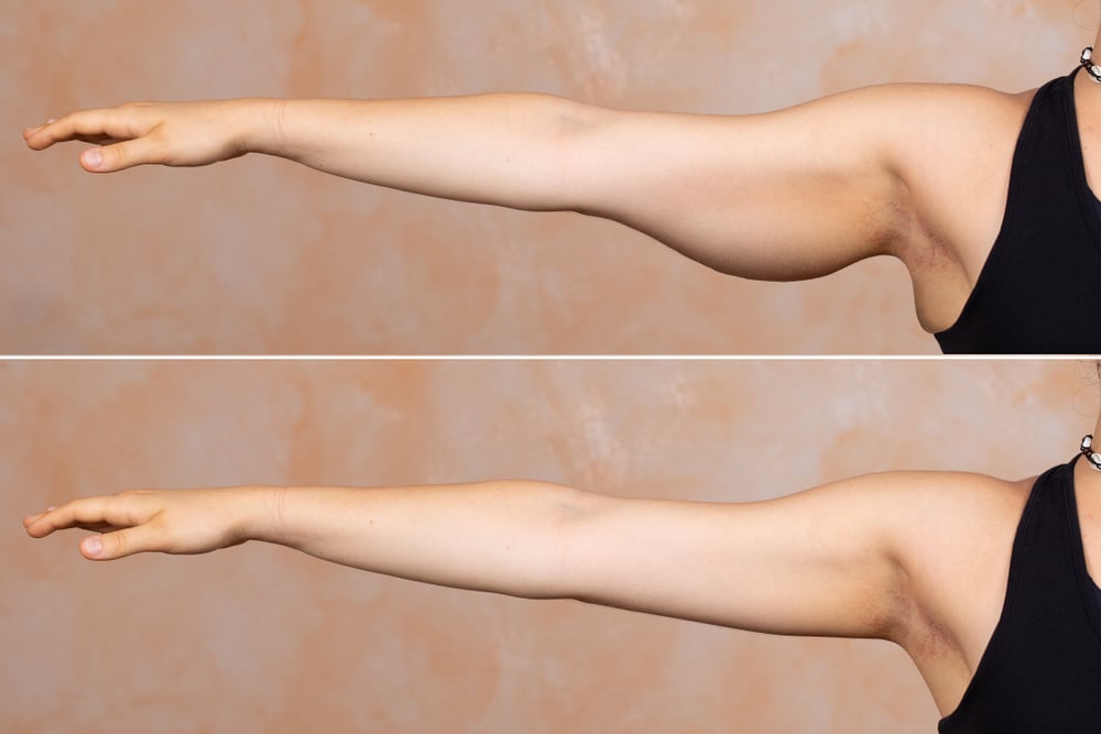 two pictures: the top one shows a woman's arm with flabby skin while the bottom shows a tighter, firmer arm