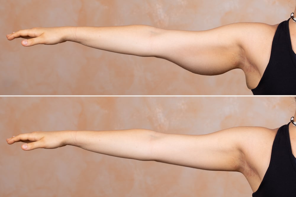 Get Rid Of Flabby Arms In One Week | The Ultimate No Equipment Arm Workout - Youtube