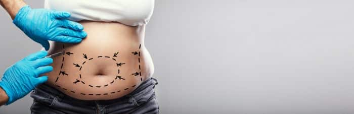 A woman's exposed midsection has surgical lines drawn on it