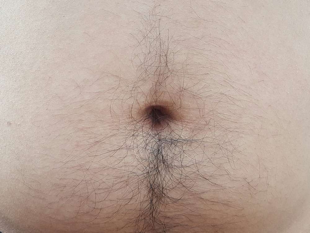 Treating Excess Fat In The Pubic Area (FUPA) - Westlake Dermatology