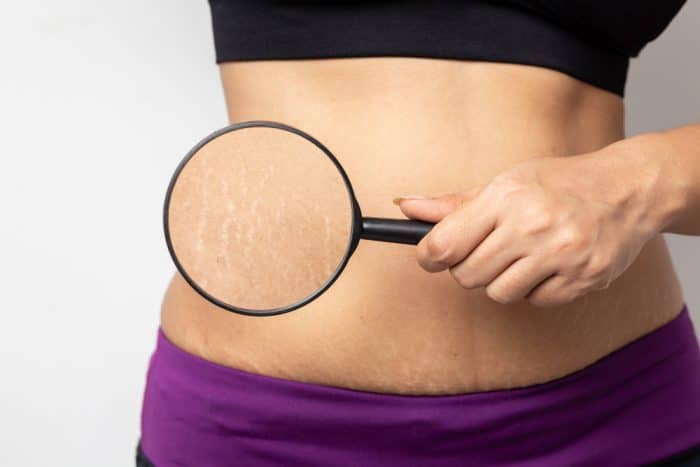 Woman holds magnifying glass to the right side of her stomach revealing stretch marks