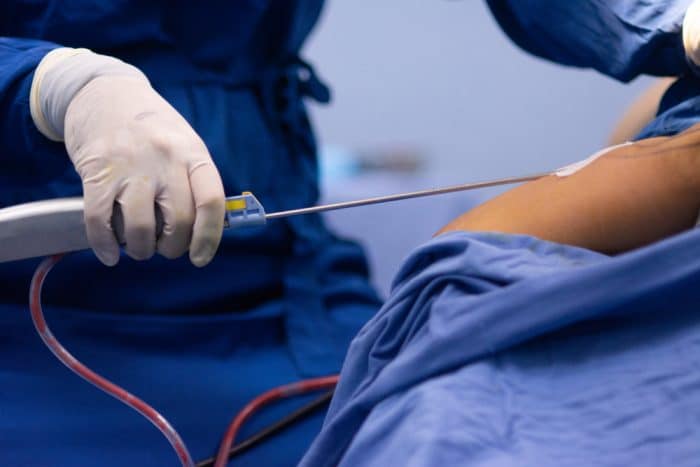 Gloved hand of a surgeon inserts a probe into a partially exposed part of a patient's body.