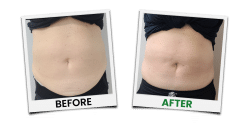 Before and after image from laser liposuction