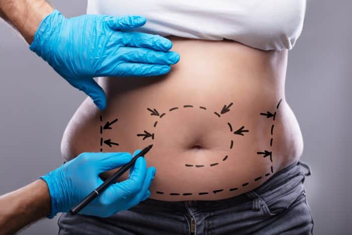 Doctor wearing gloves outlines woman's abdomen and belly button with marker showing wear she will receive liposuction surgery.