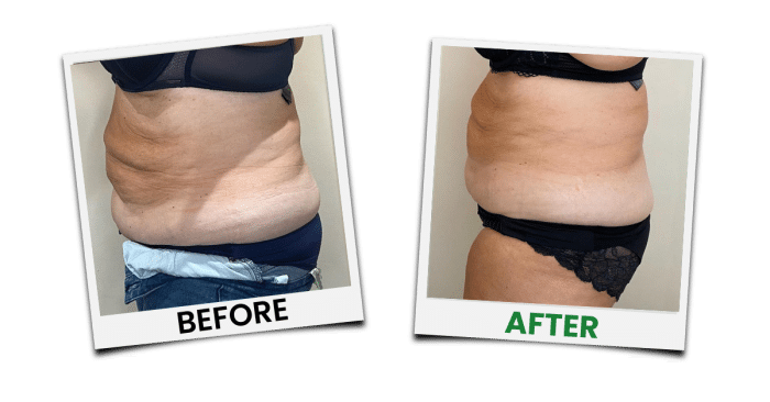 Emerald Laser before-and-after results showcasing a slimmer waistline and improved body tone through non-invasive fat reduction.