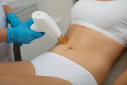 laser fat reduction